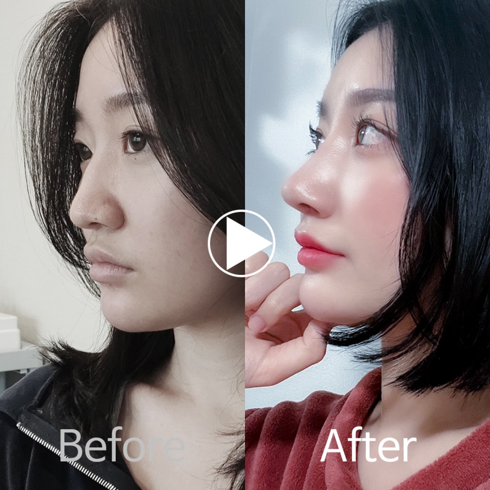 🎀앤플러스 코성형 모델모집🎀 관련 이미지 11