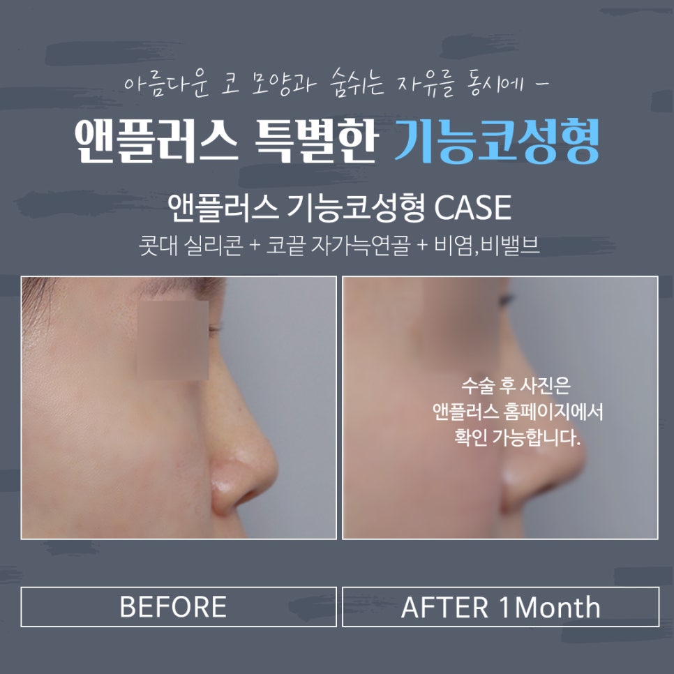 Rhinoplasty Review That Also Improved Function image 11