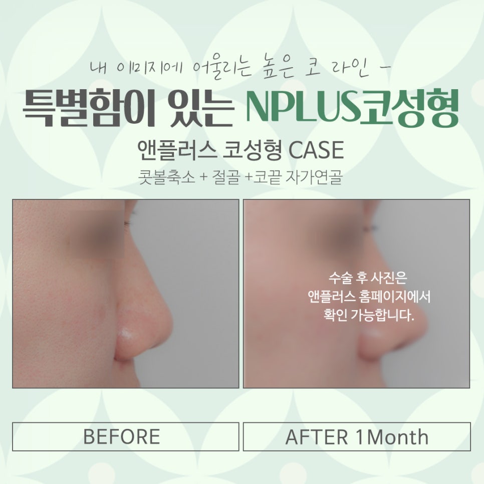 서울코성형잘하는곳 개인의 이미지를 고려하여 관련 이미지 14