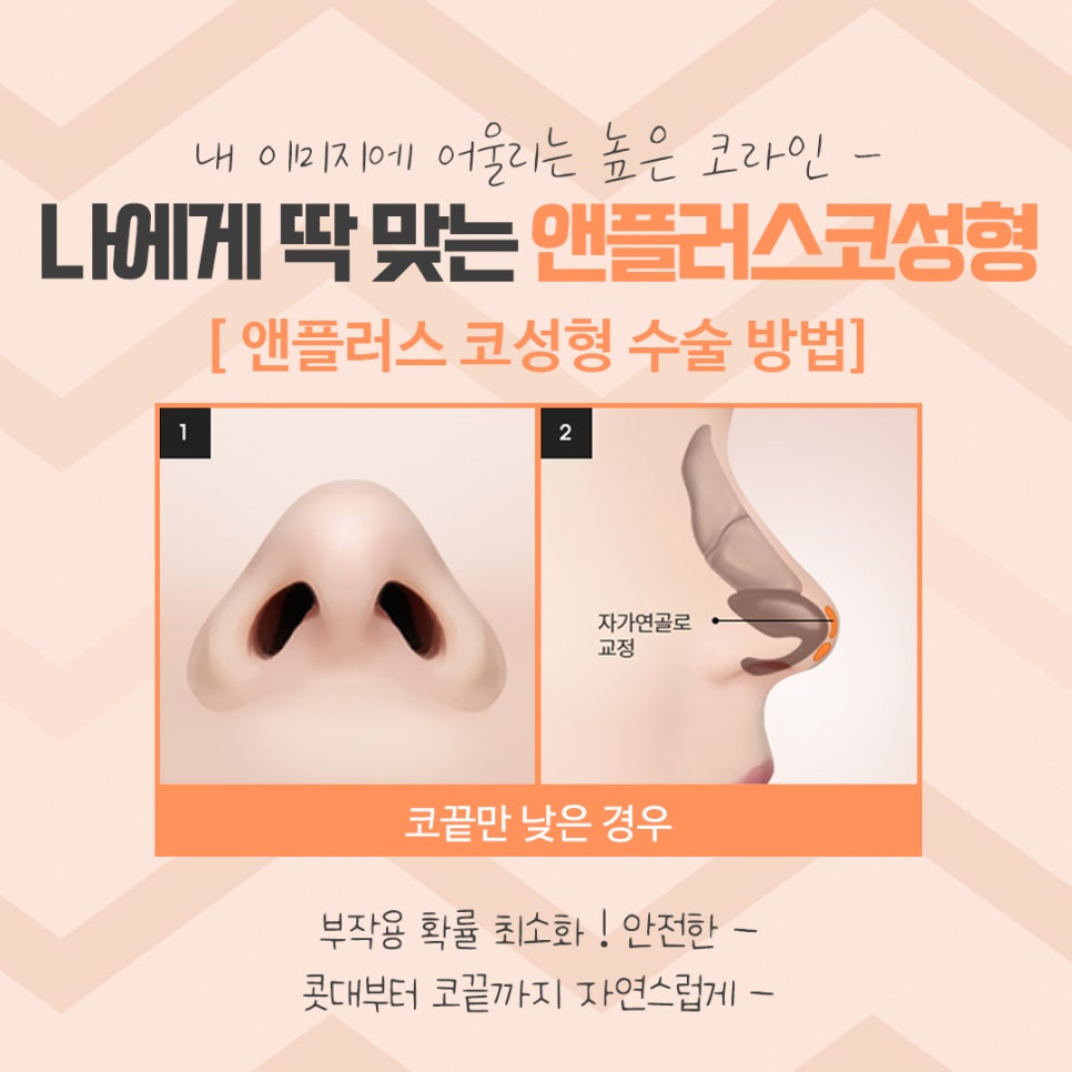 코성형 후기로 알아보고 결정 관련 이미지 11