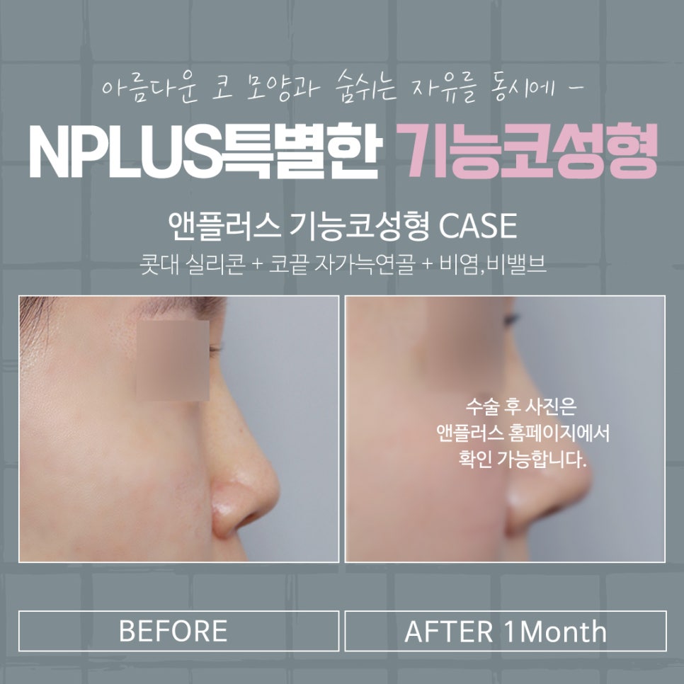 코성형후기 자연스럽고 예쁘게 관련 이미지 15