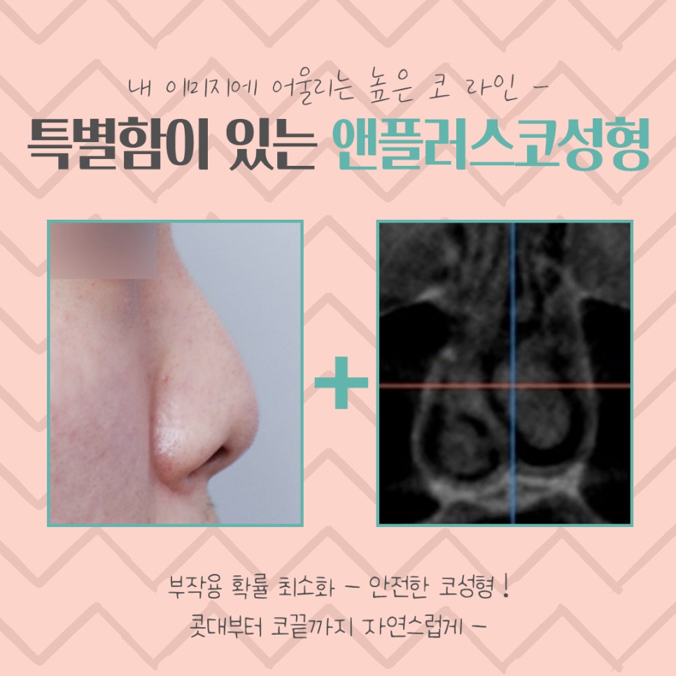 Nose Surgery Review Considering the Straight-Humped, Straight-Half-Moon Line image 5