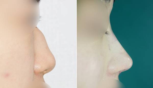 앤플러스 여자매부리코 전후사진 관련 이미지 1