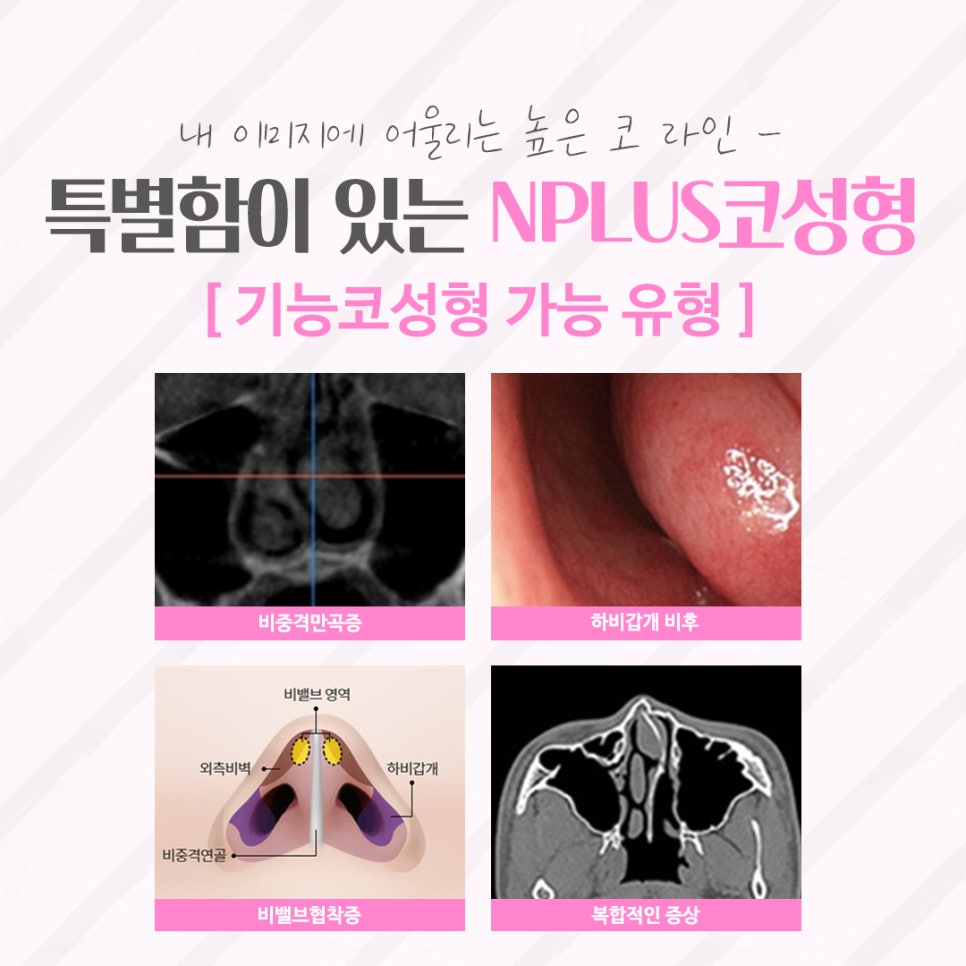 압구정코수술 자연스러운 라인으로 관련 이미지 4