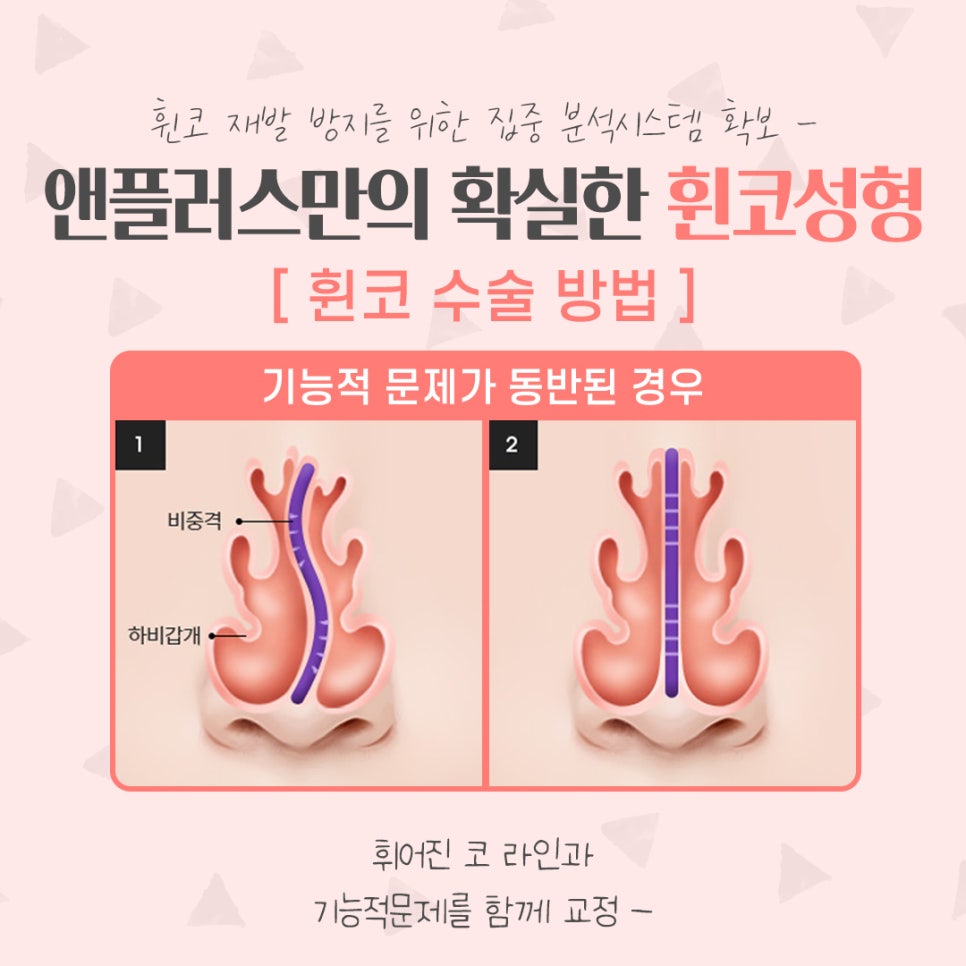 휜코수술후기 정확한 진단을 통해 관련 이미지 9