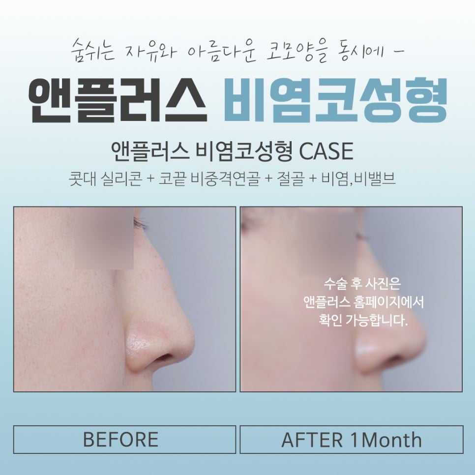 비염코수술전후에 대해 자세히 알아보고 관련 이미지 13