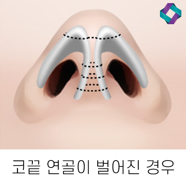 복코성형 유형에 따라 다른 수술방법 관련 이미지 3
