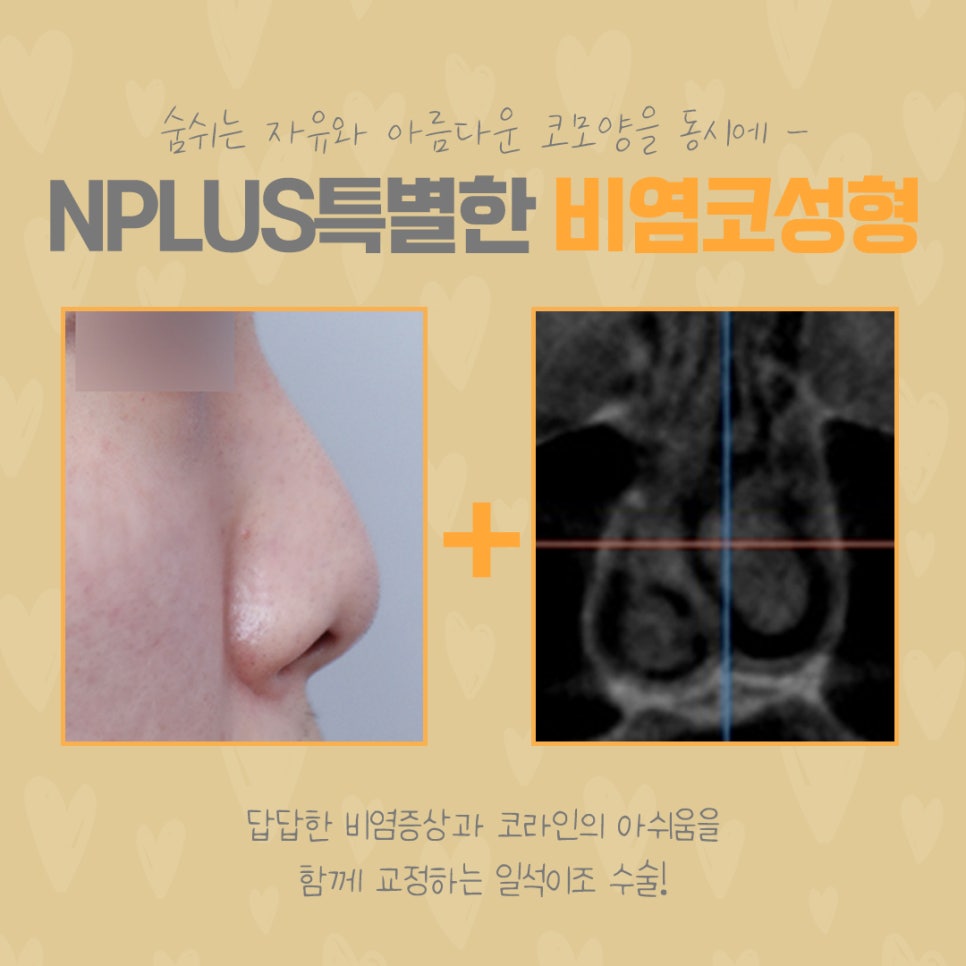 코막힘원인 정확하게 파악하는 것이 중요 관련 이미지 6