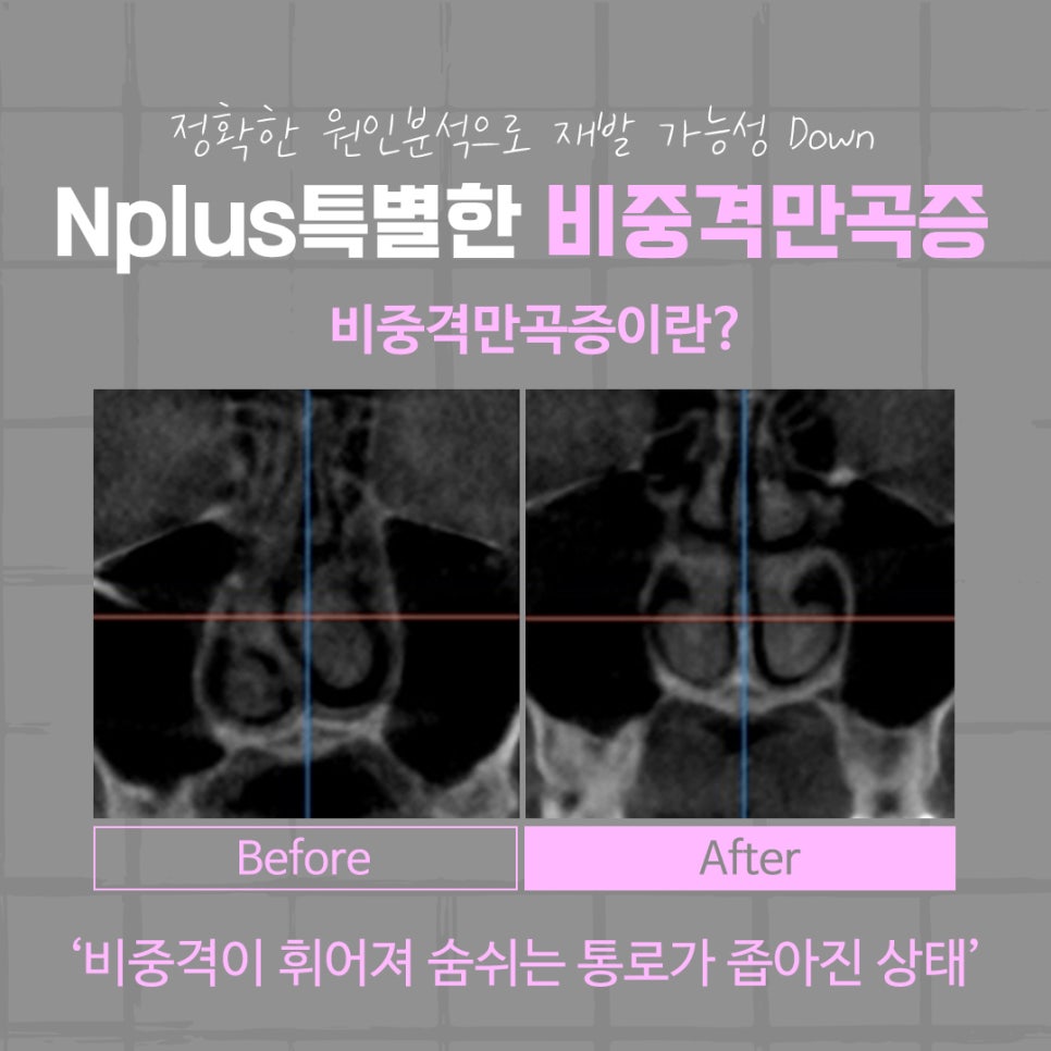 비중격만곡증수술 후기를 알아보고 결정 관련 이미지 5