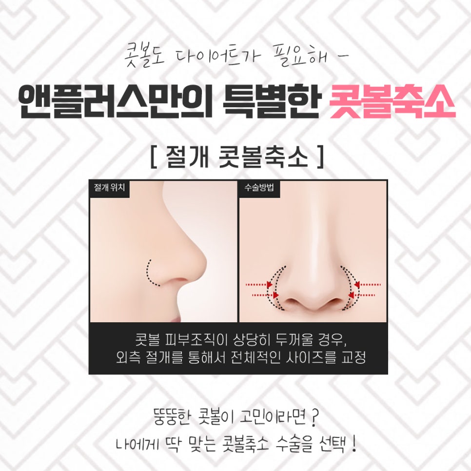 콧볼축소후기 넓은 콧볼이 고민이라면 관련 이미지 10