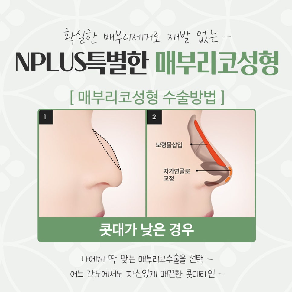 Hump Nose Surgery Review: Check Carefully image 9