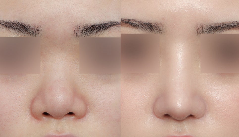 Upturned Nose Surgery_Naturally with Tip Lengthening image 2