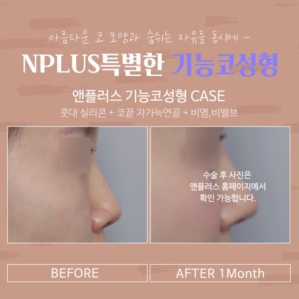 기능코수술후기 정확하게 알아보고 관련 이미지 14