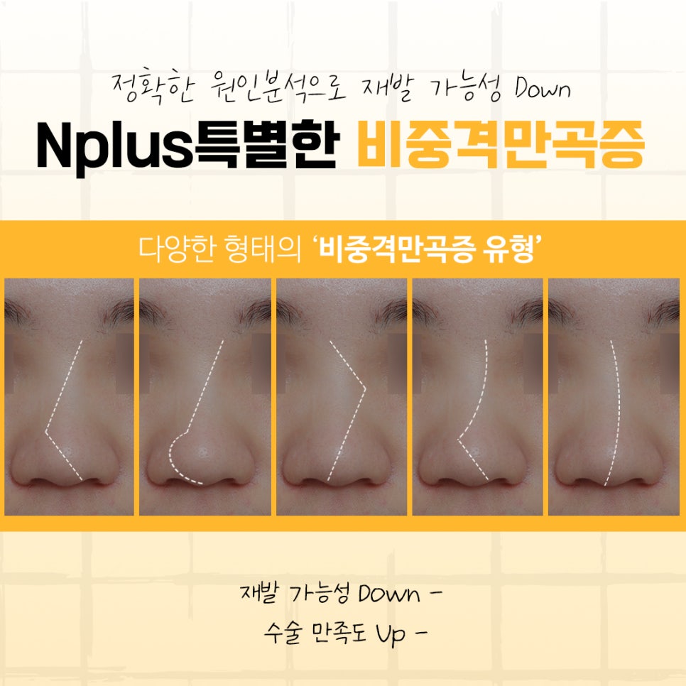 비중격만곡증수술후기에 대해 신중하게 찾아보고 관련 이미지 7