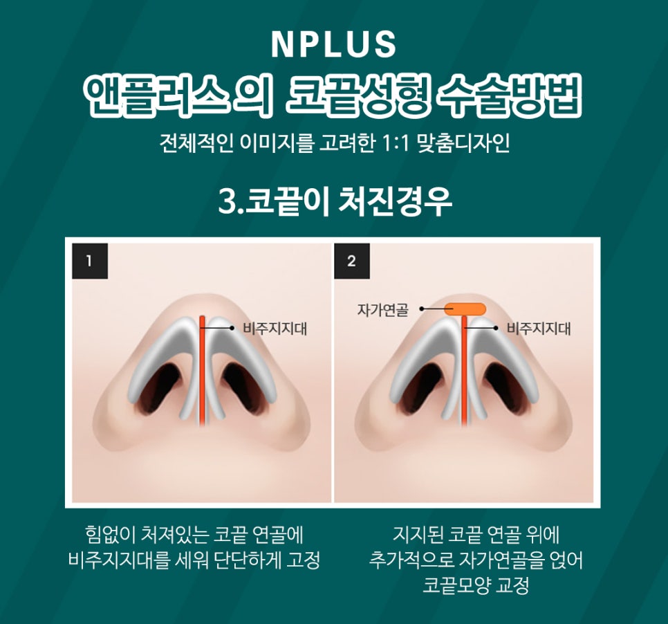 A Detailed, Careful Review of Tip Rhinoplasty image 7