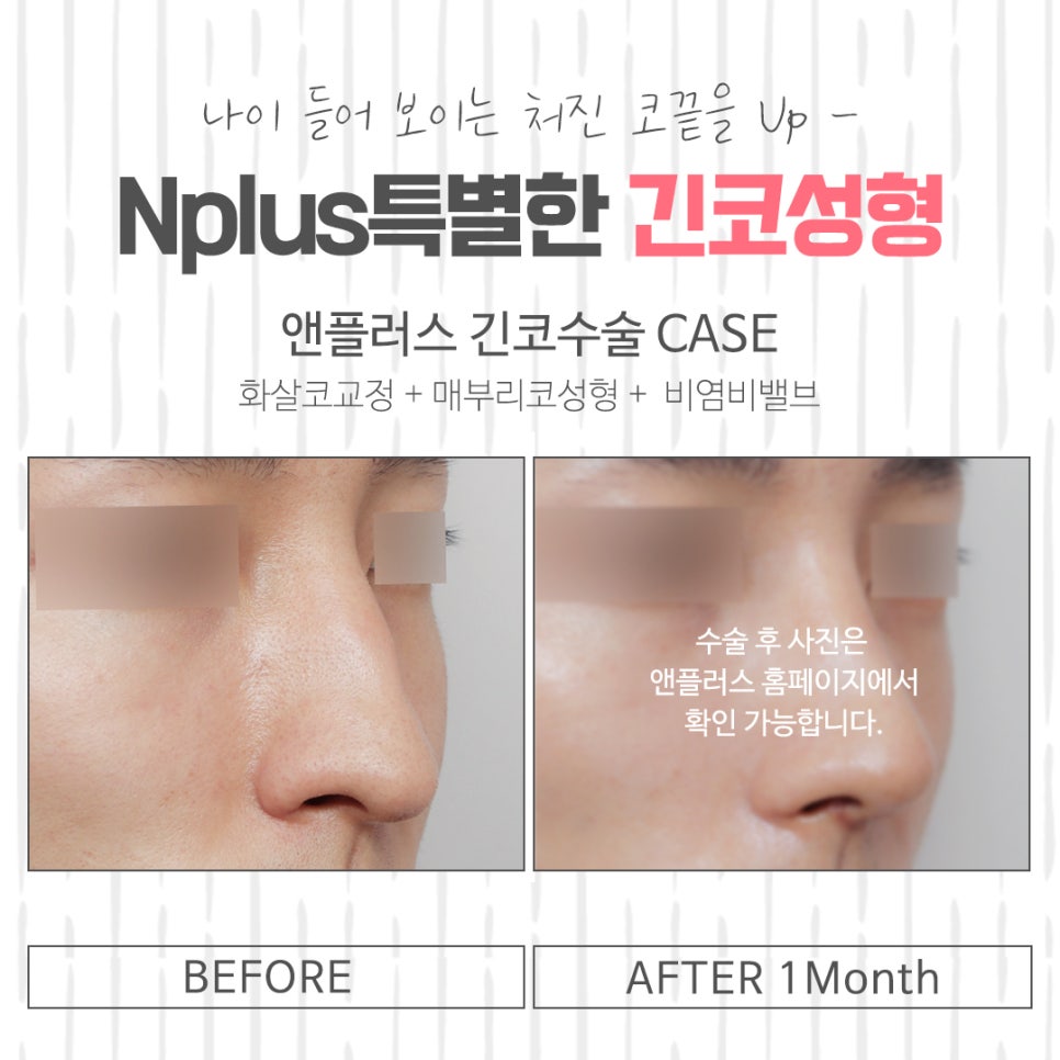 긴코성형 후기까지 알아보고 관련 이미지 16