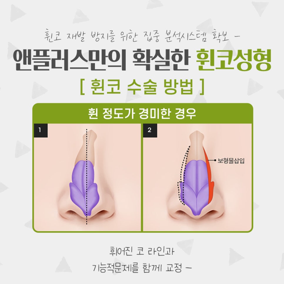 Whistling Nose Surgery Review: A Natural and Beautiful Line image 7