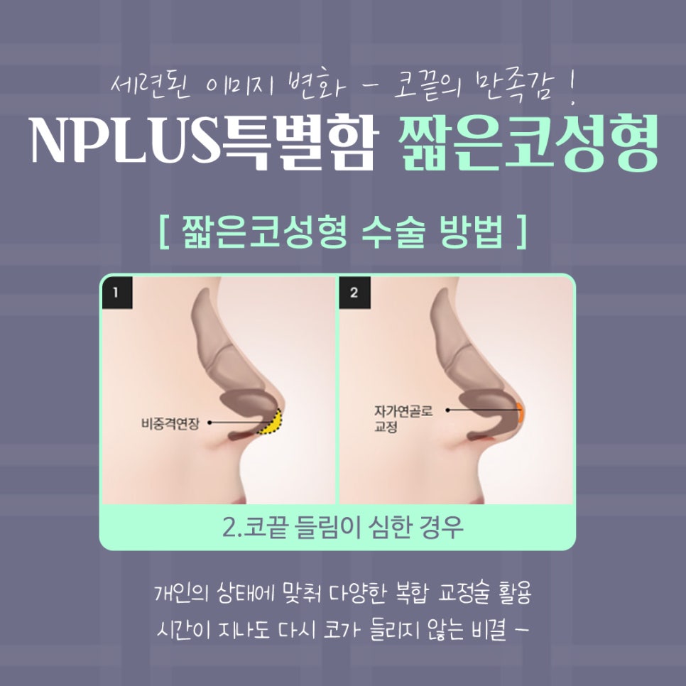 짧은코성형 후기를 보고 개선된 점 알아보기 관련 이미지 10