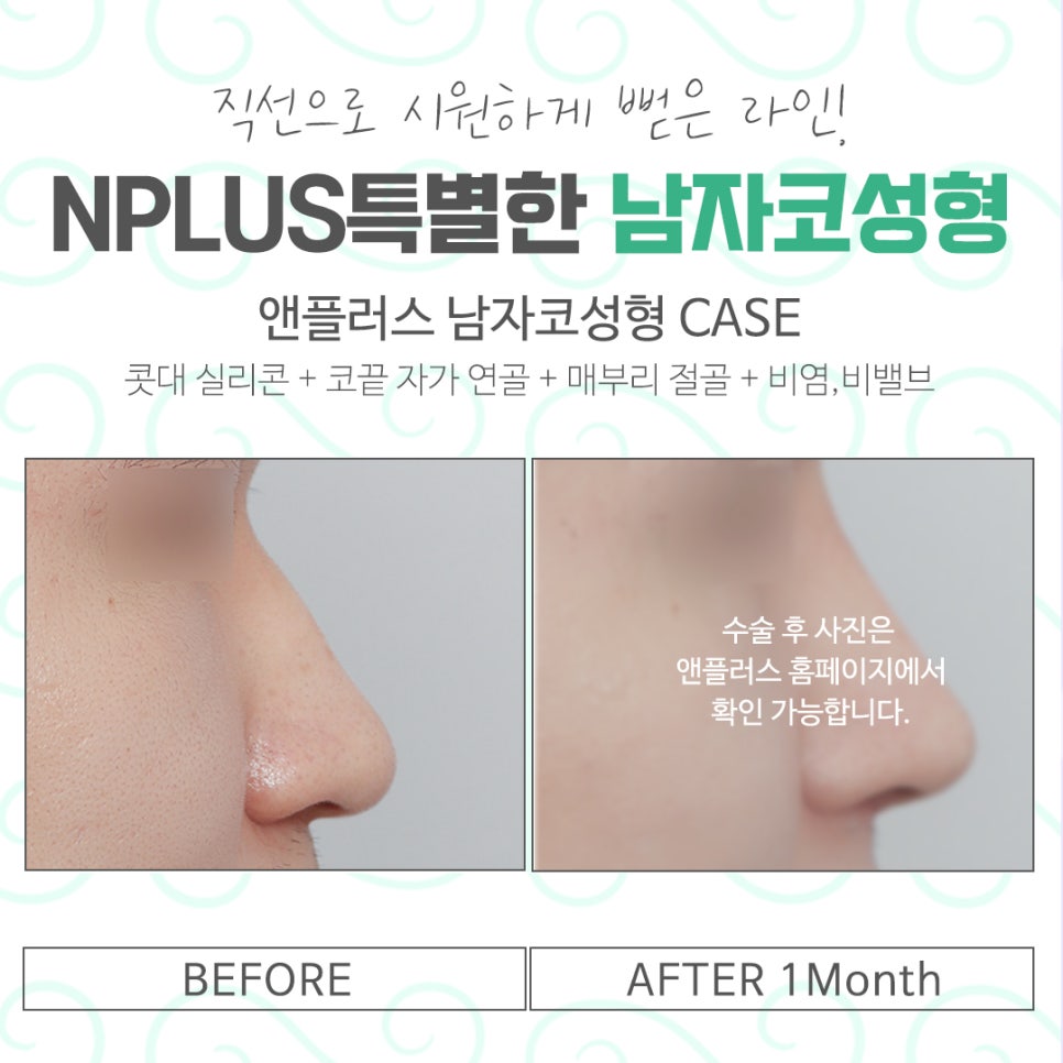 남자코성형 전체적인 라인을 고려하여 관련 이미지 14