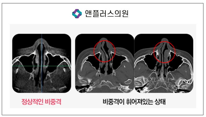 코재수술 1:1맞춤수술법 파헤치기 관련 이미지 7