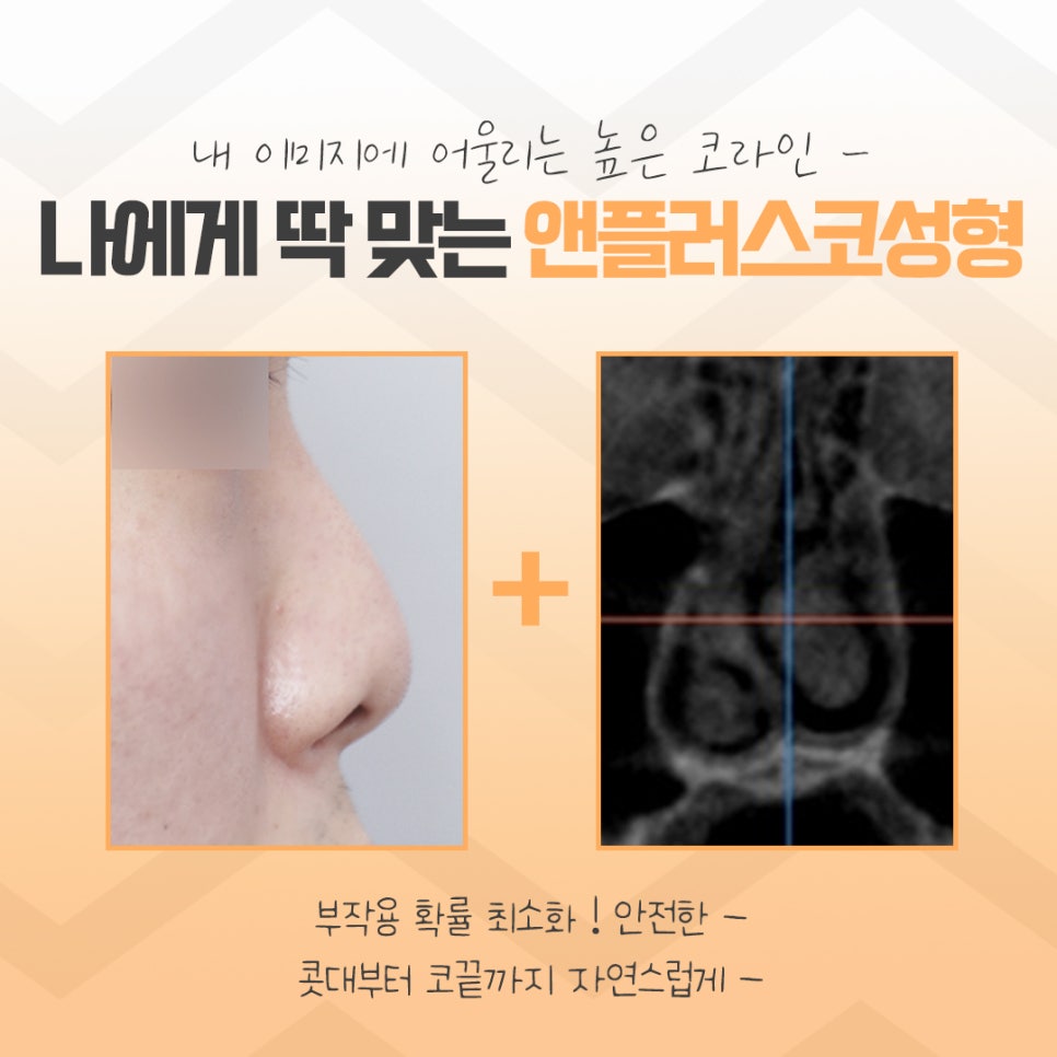 코수술후기에 대해 자세히 찾아보고 관련 이미지 11