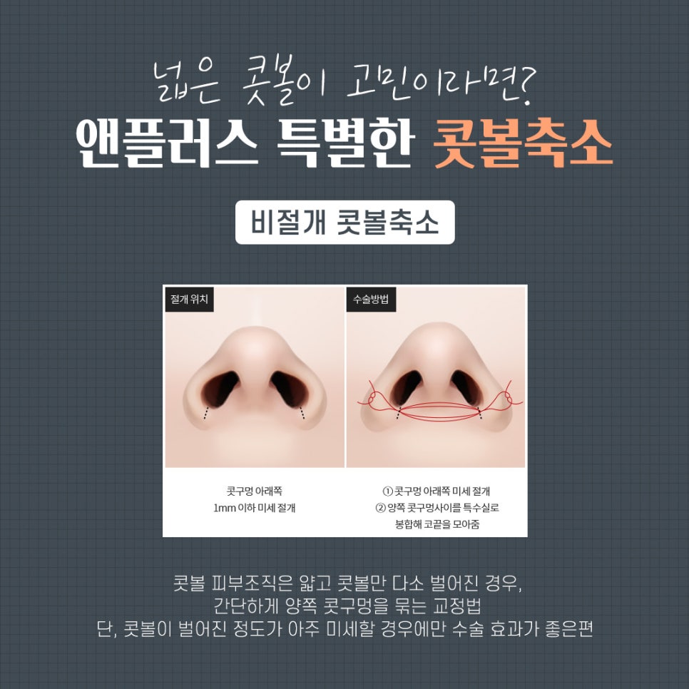 콧볼축소수술 흉터 없이 자연스럽게 관련 이미지 6