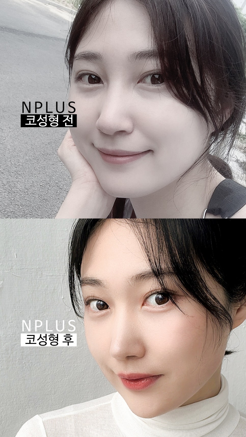 앤플러스에서 진행된 매부리코성형후기 관련 이미지 16