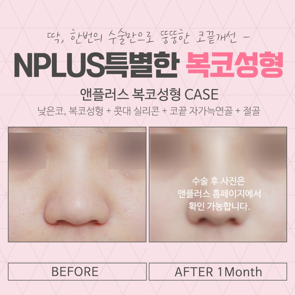 코지방제거를 통해 세련된 라인으로 관련 이미지 15