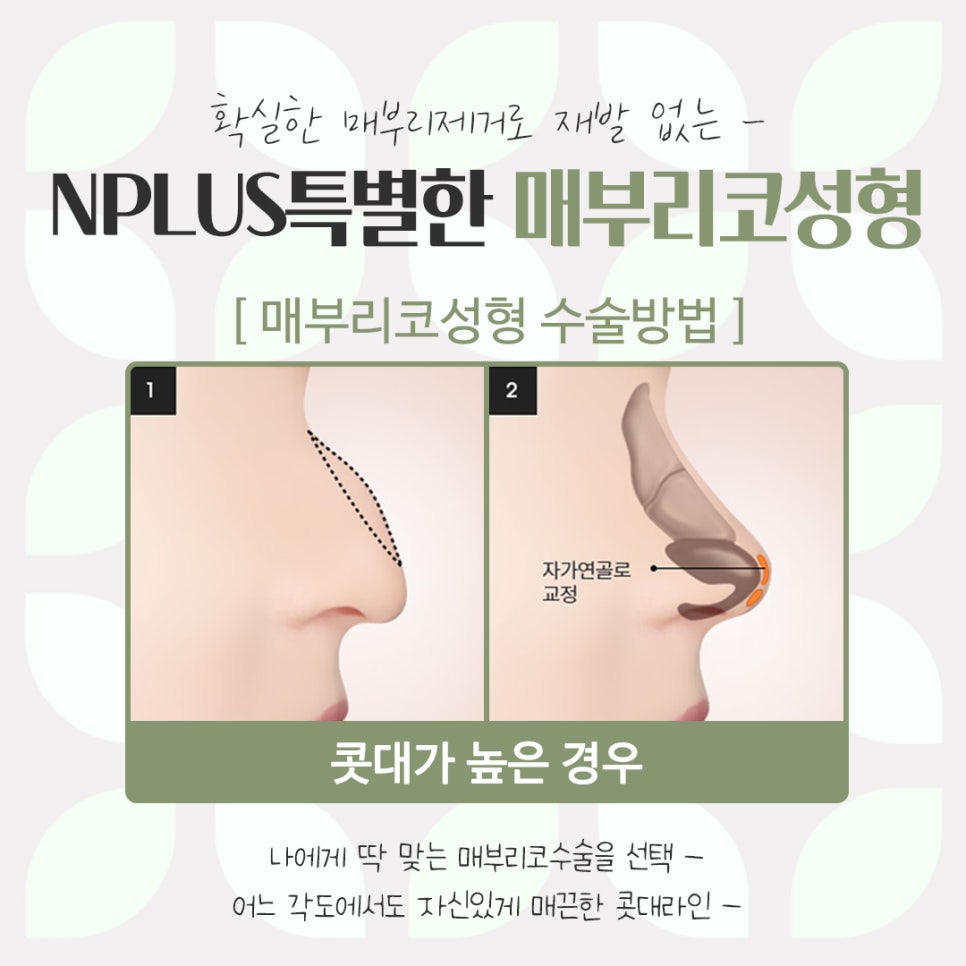Detailed Hump Nose Surgery Review image 10