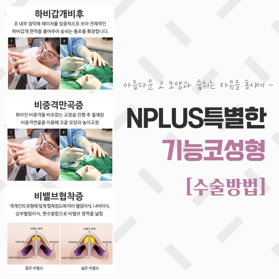 코성형실비를 알아보고 결정 관련 이미지 8