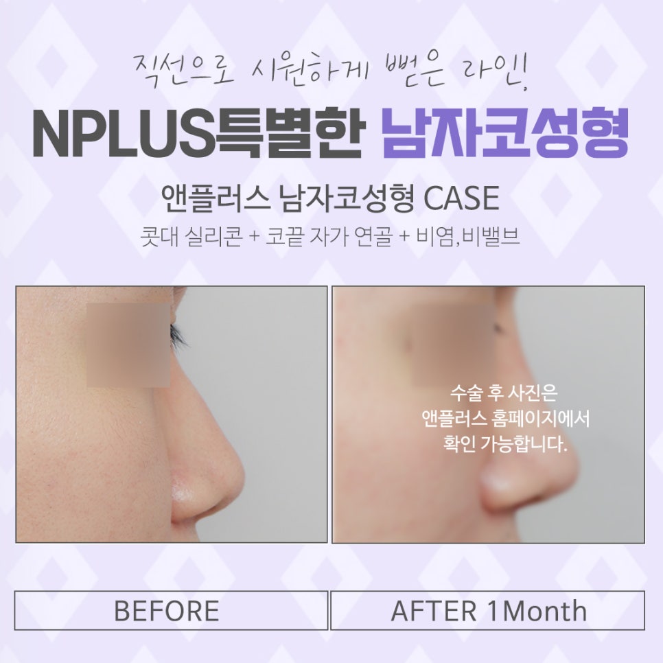 A Nose Line That Suits You, Even in Men's Rhinoplasty Reviews image 13