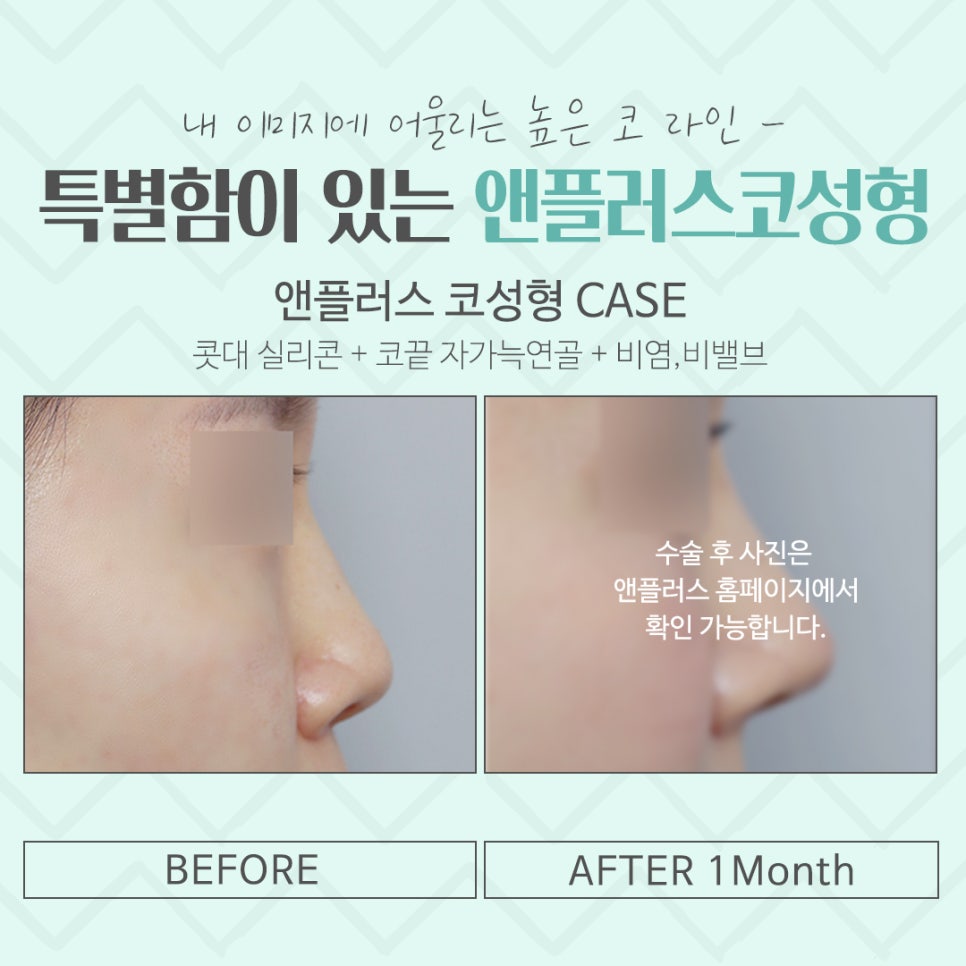 Rhinoplasty Review Considering Functional Aspects image 17