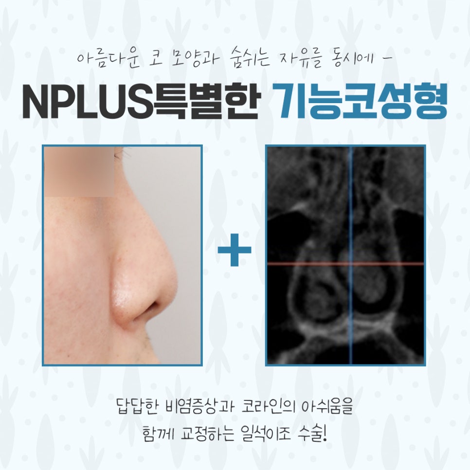 기능코수술후기에 대해 다양하게 알아보고 관련 이미지 3
