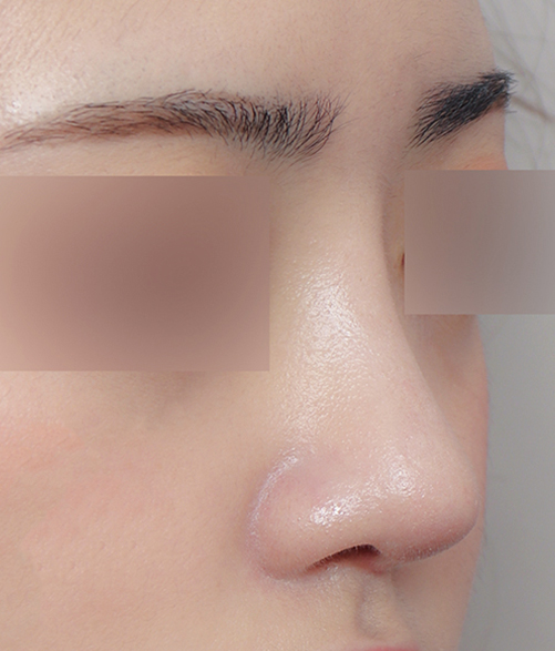 Upturned Nose Surgery_Naturally with Tip Lengthening image 8