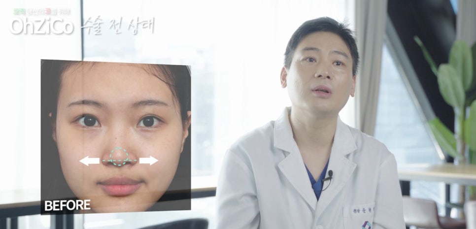 짧은코수술 후기까지 자세하게 알아보고 관련 이미지 4