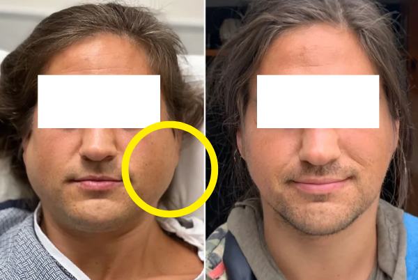 Read This Before You Regret Getting Salivary Gland Botox in Hongdae image 2