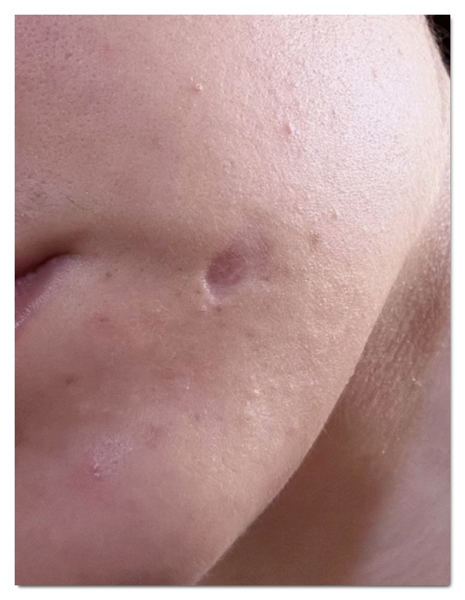 홍대 점빼기 흉터 없이 깔끔하게 없애는 방법 관련 이미지 3
