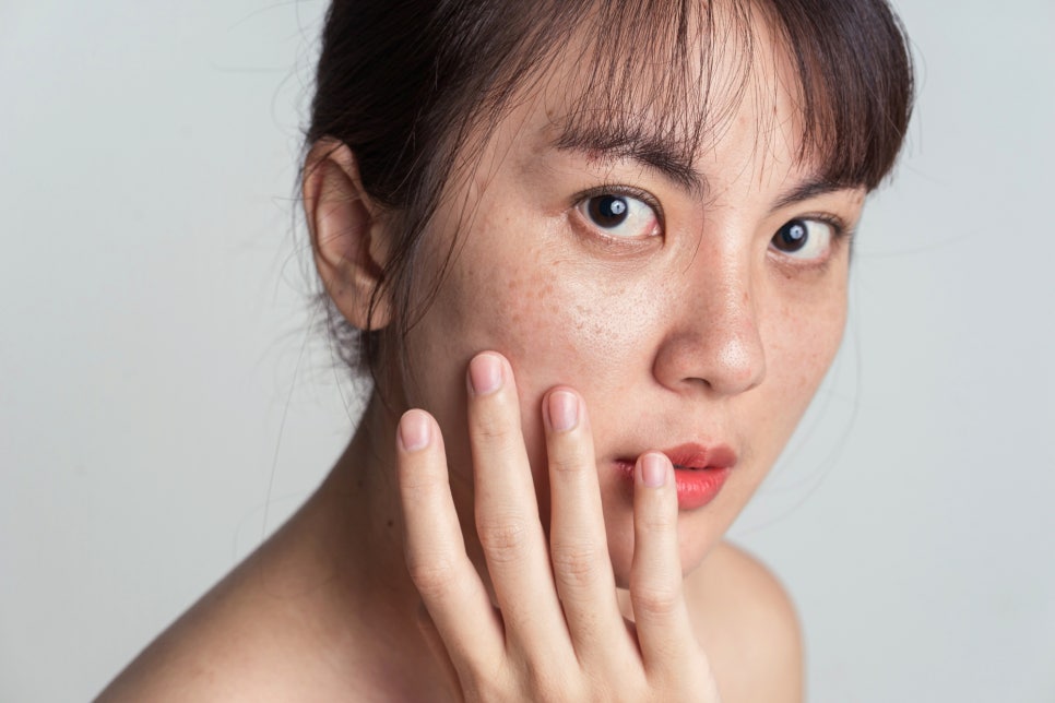 이대역피부관리, 지저분한 잡티 고민 색소레이저로 해결하세요(근처10분거리) 관련 이미지 3