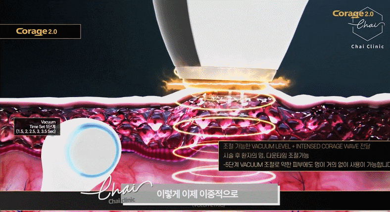 코레지리프팅, ‘이것’이 싫으신 분에게 추천! 관련 이미지 3