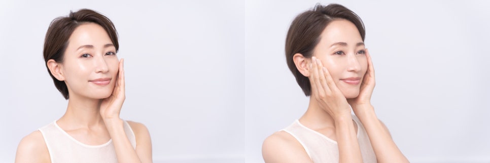 볼살시술 차이의원 조각주사로 한번에 해결! 관련 이미지 10