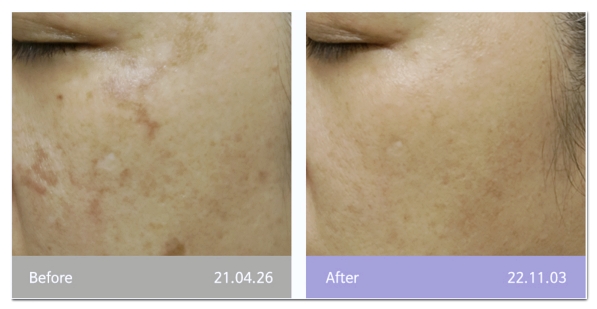 No Results from Hongdae Pico Toning? Check These 5 Things image 6