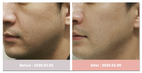 Mapo Botox: 3 Things to Check Before You Regret Getting It Cheap image 7