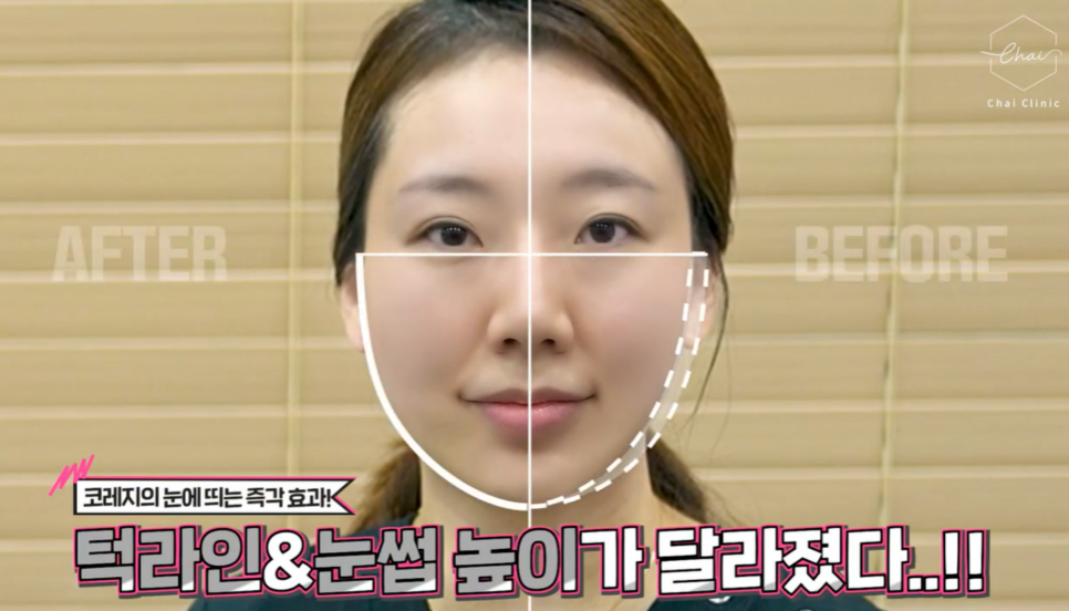 통증 없는 눈가리프팅 ‘OOO’가 최선입니다! 관련 이미지 1