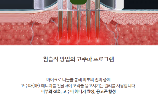 홍대 포텐자 모공 고민 해결을 위한 선택! 관련 이미지 4
