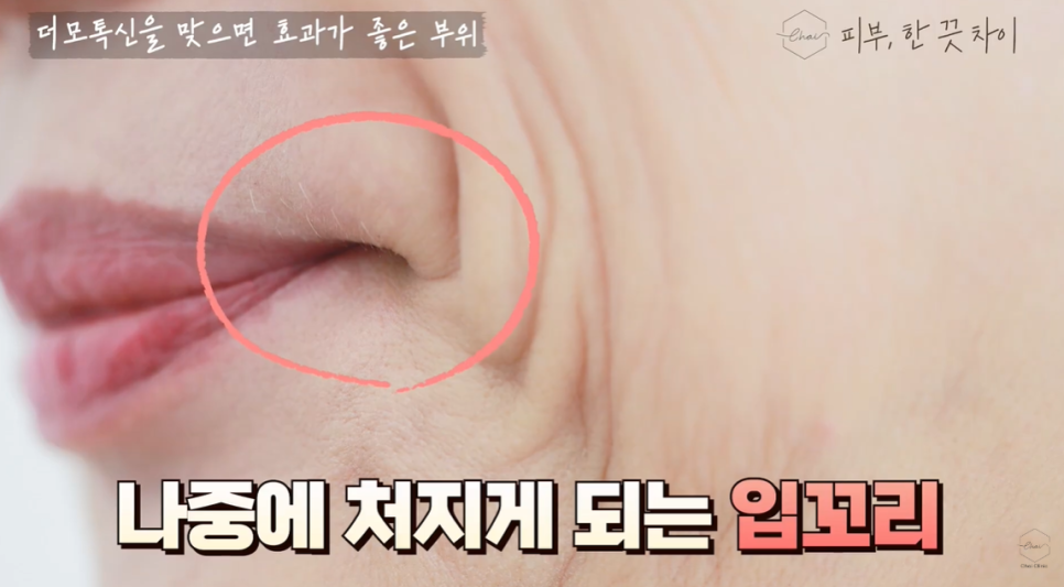 3 Things You Need to Know If You Don’t Want Botulinum Toxin Treatment in Hapjeong to Leave You Asymmetrical image 5