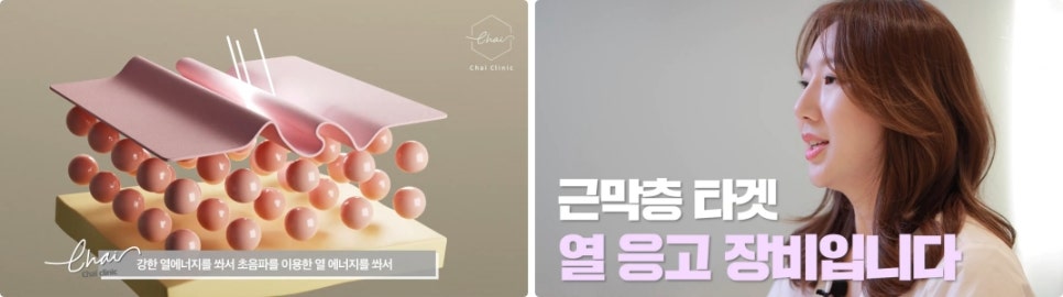 이마 실리프팅, &lsquo;OO&rsquo;을 잡아야 최상의 효과를 볼 수 있습니다. 관련 이미지 4
