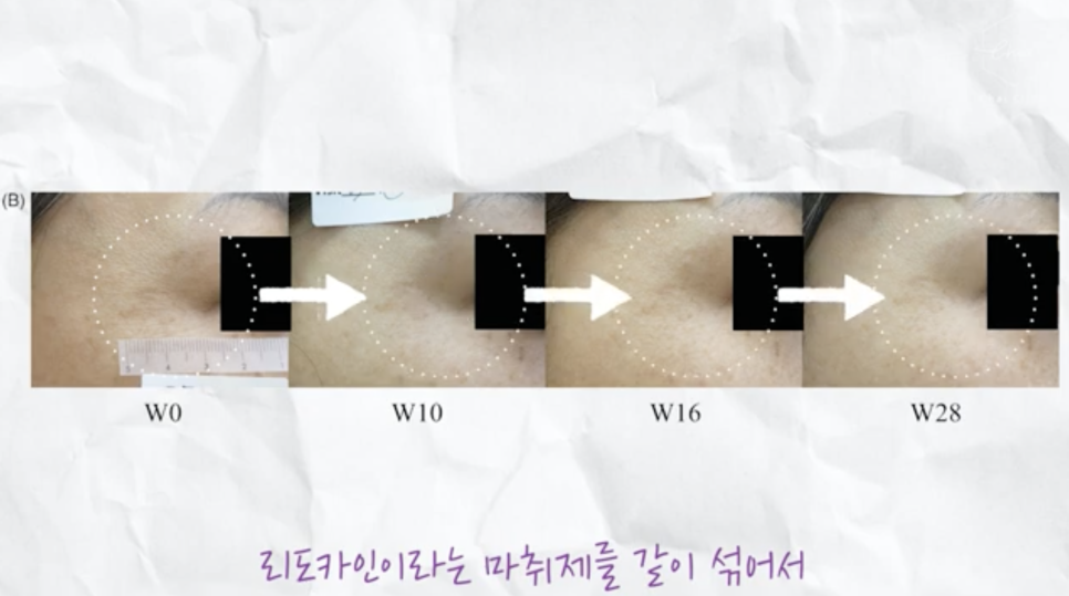 리쥬란 HB 통증에 대한 견해 관련 이미지 6