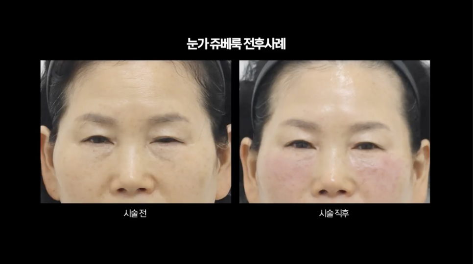 눈밑 쥬베룩 볼륨의 효과와 유지기간 관련 이미지 1