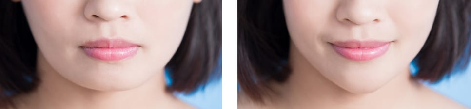 마포역보톡스, 더 예뻐질 당신을 위해 관련 이미지 3