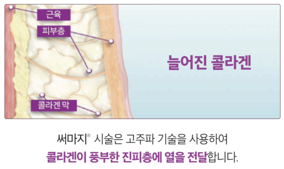 고주파 리프팅 종류와 차이의원의 리프팅 솔루션 관련 이미지 10